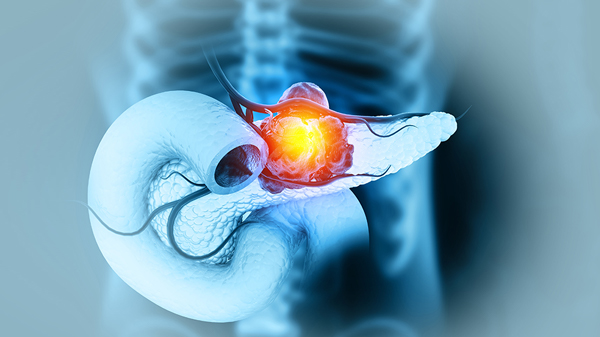 췌장암 악성유형 유발하는 종양미세환경인자 첫 규명